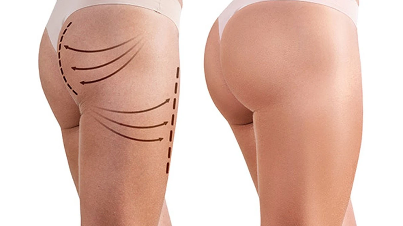 Dumba Estetikasi (Gluteoplastika)