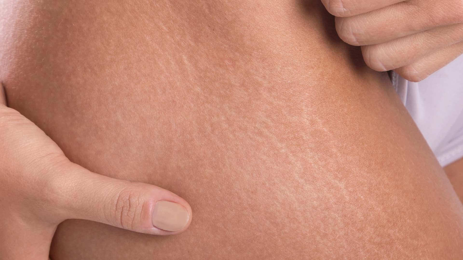 Lazer Bilan Striyalarni (Teri Yorilishlarini) Davolash