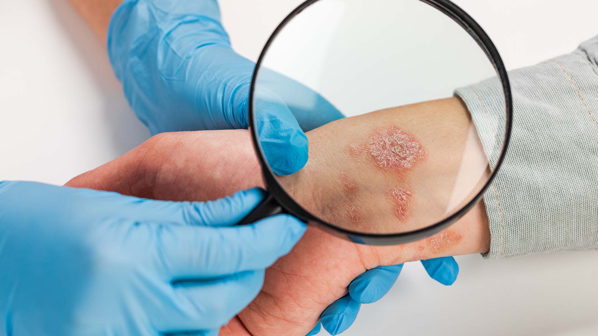 Psoriazni Davolash