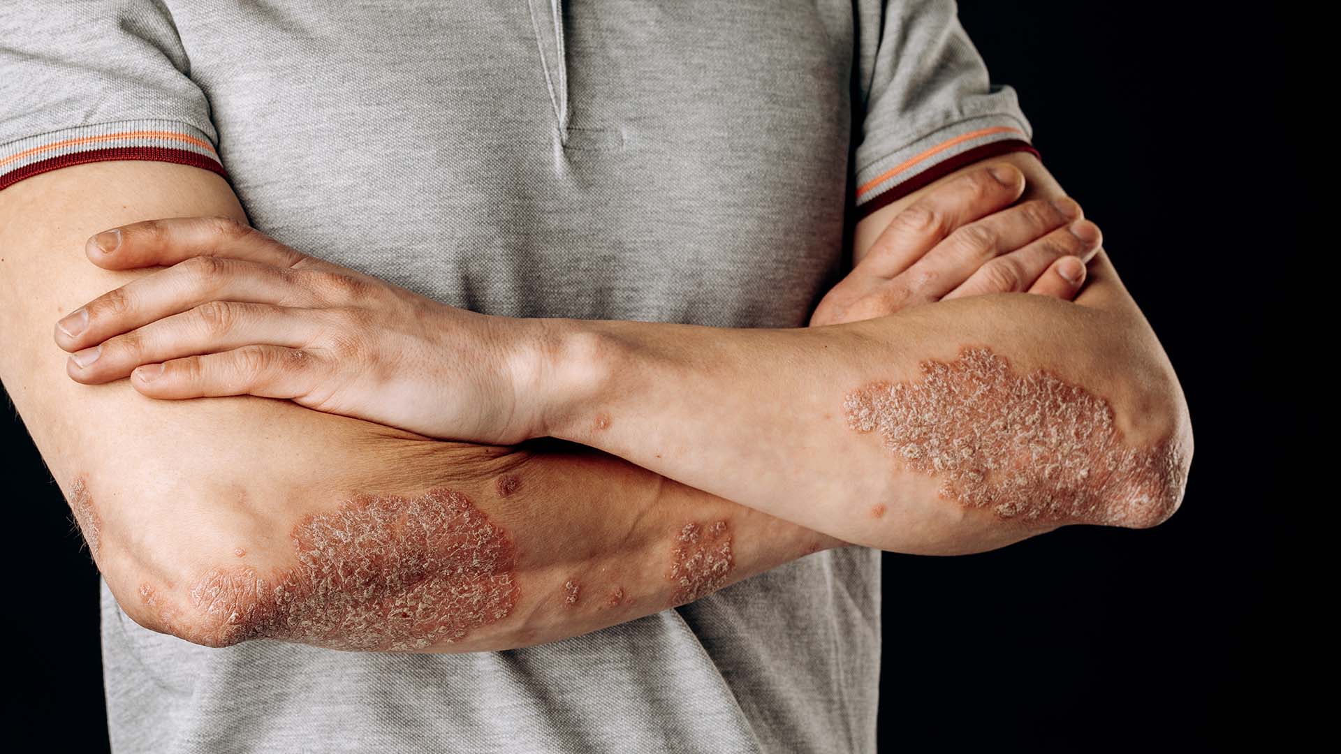 Psoriazni Davolash
