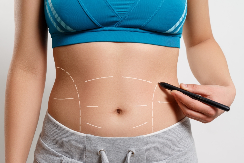 Qorin Tortish Operatsiyasi (Abdominoplastika)