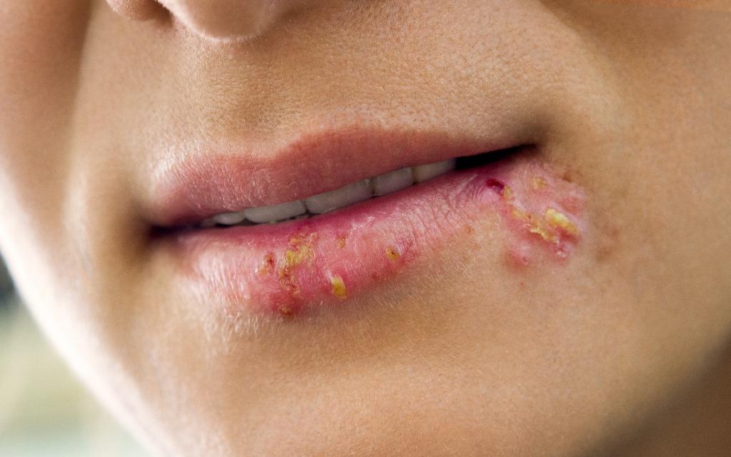Gerpes nima: Virus turlari, belgilari va davolash usullari