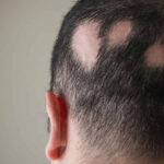 Alopesiya: bu nima, sabablari va sochni tiklash usullari