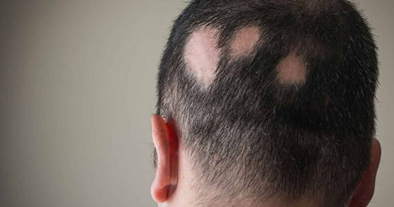 Alopesiya: bu nima, sabablari va sochni tiklash usullari