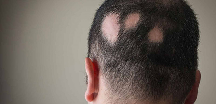 Alopesiya: bu nima, sabablari va sochni tiklash usullari