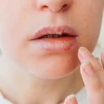 Herpes nima: bolalarda turlari, xususiyatlari va davolash usullari