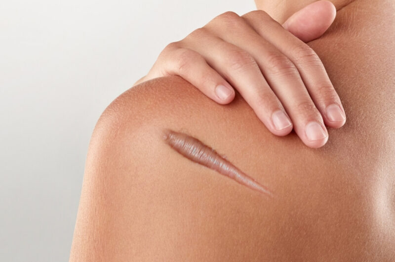 Keloid chandiq nima: sabablari va davolash usullari