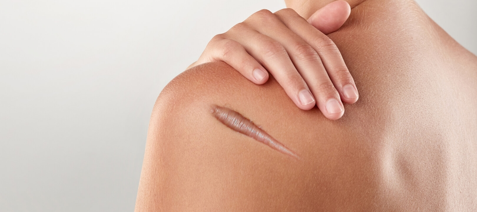 Keloid chandiq nima: sabablari va davolash usullari