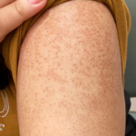 Keratoz Pilaris: sabablari, belgilari va terini parvarish qilish