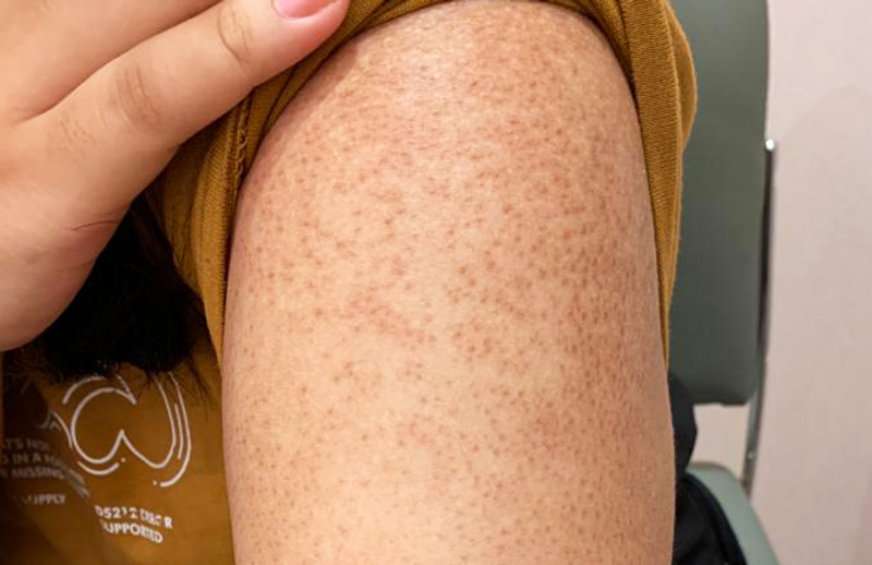 Keratoz Pilaris: sabablari, belgilari va terini parvarish qilish