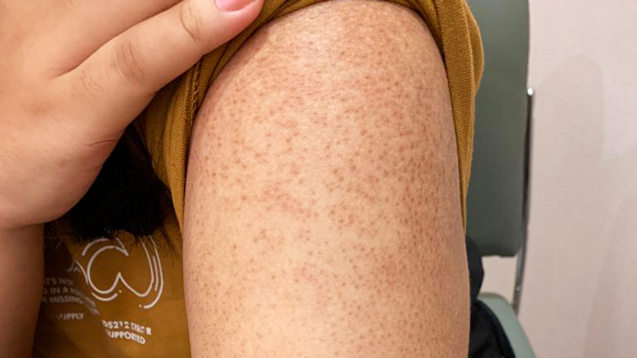 Keratoz Pilaris: sabablari, belgilari va terini parvarish qilish