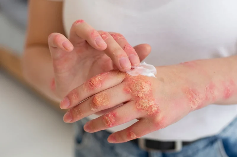 Psoriaz turlari: shakllari, sabablari va davolash usullari