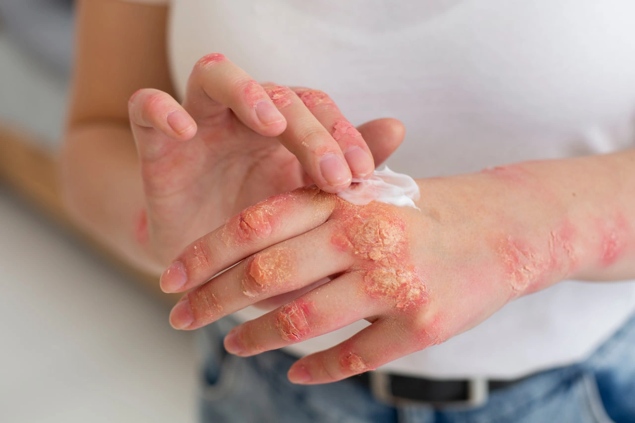 Psoriaz turlari: shakllari, sabablari va davolash usullari